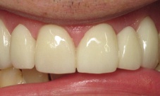 Upper crowns and bridge to correct alignment, replace missing teeth, close spacing and discoloration.