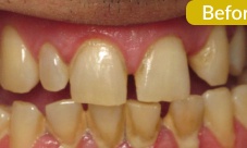 Upper crowns and bridge to correct alignment, replace missing teeth, close spacing and discoloration.