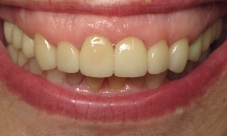 Upper canine to canine crowns with gingival contouring to correct gum line, discoloration, alignment and
fractured teeth.
