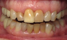 Upper canine to canine crowns with gingival contouring to correct gum line, discoloration, alignment and
fractured teeth.