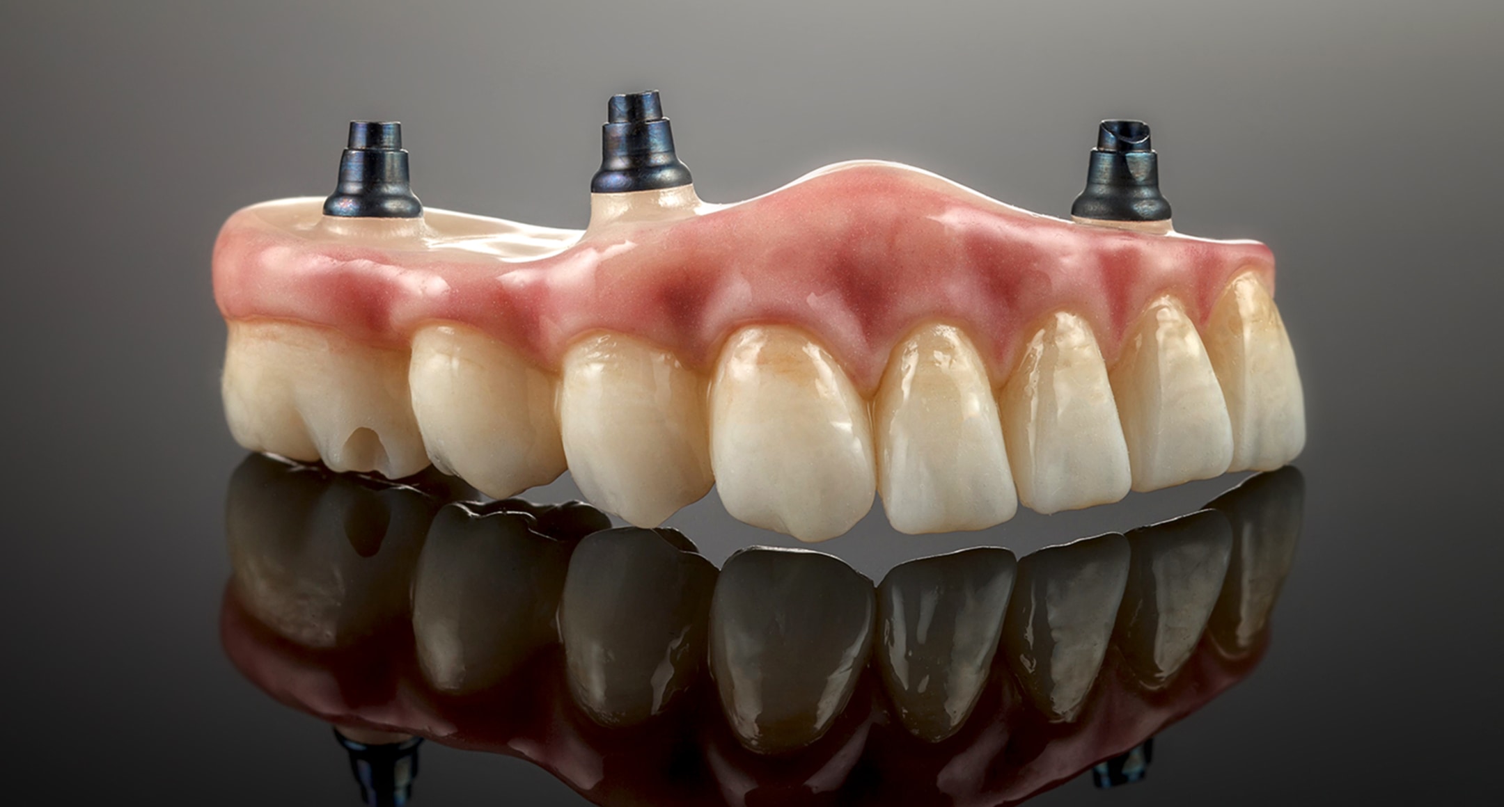 Cosmetic Dentistry Trends: How Modern Implant-Supported Dentures Restore Confidence for Patients
